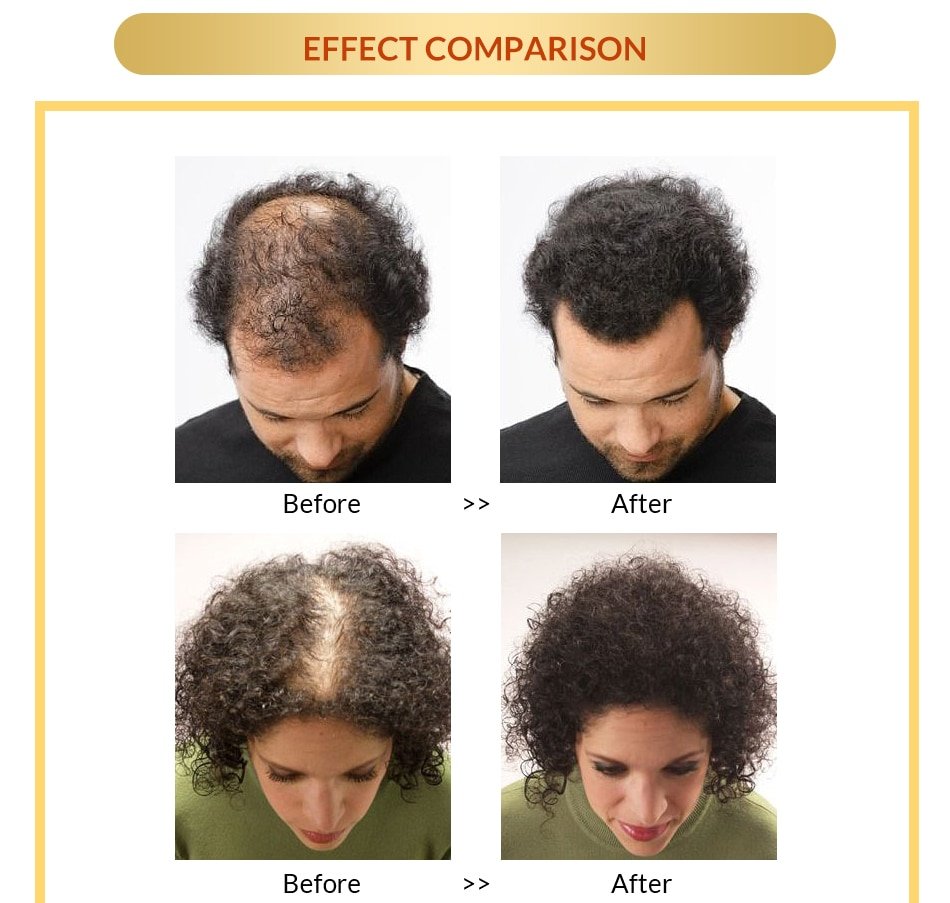Anti Hair Loss And Growth Spray Oil For Men Women Anti Hair Loss And Growth Spray Oil For Men Women