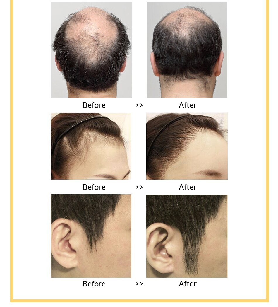 Anti Hair Loss And Growth Spray Oil For Men Women Anti Hair Loss And Growth Spray Oil For Men Women